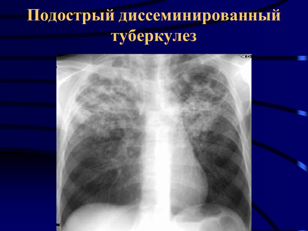 МФ БГУ Мархаев А.Г. Подострый диссеминированный туберкулез
